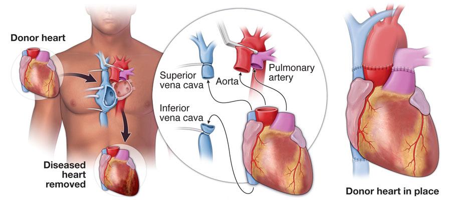 Getting a heart transplant illustration